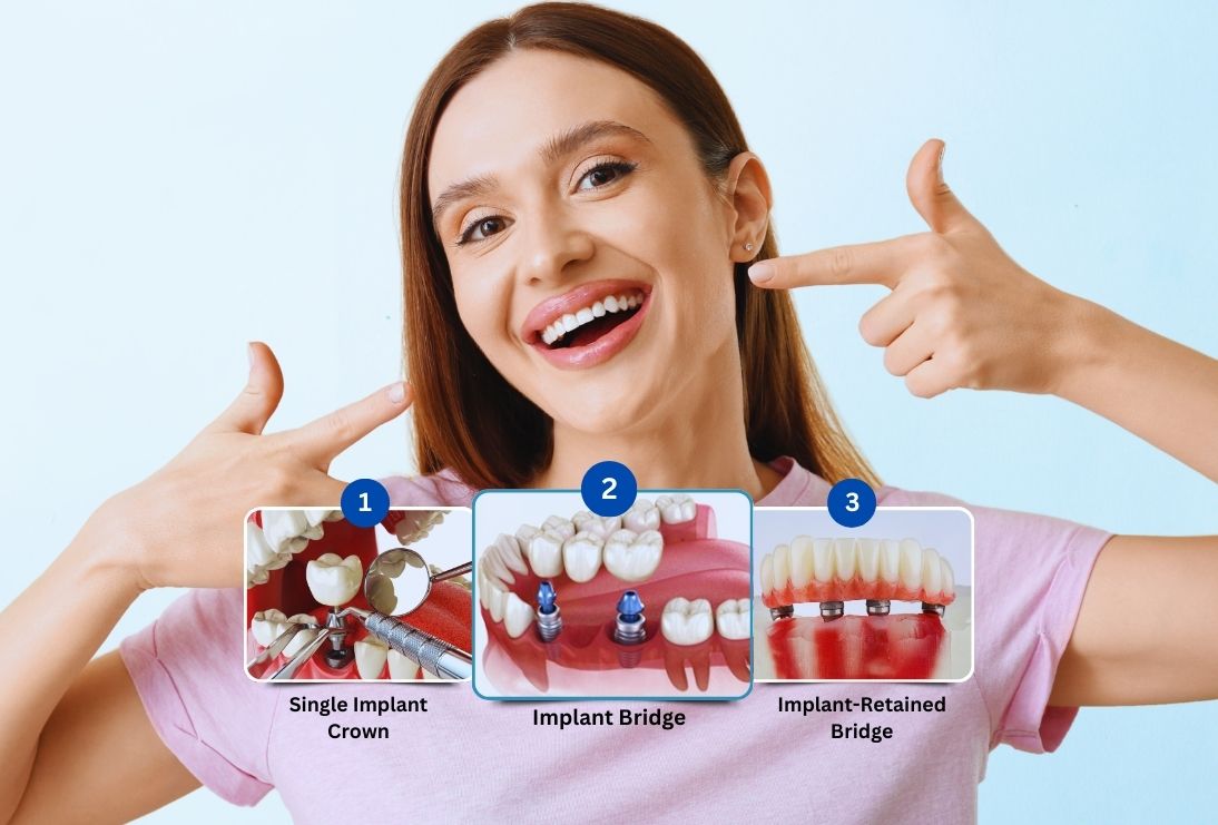 Implants: Why It's Important to Replace Missing Teeth